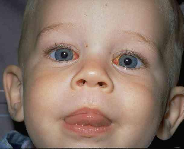 Strabismus Strabismus Question And Answers Firmoo Answers